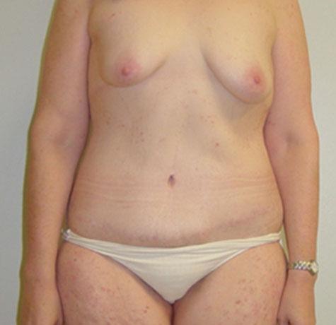 Tummy Tuck after at Neal Goldberg, MD in Scarsdale, NY
