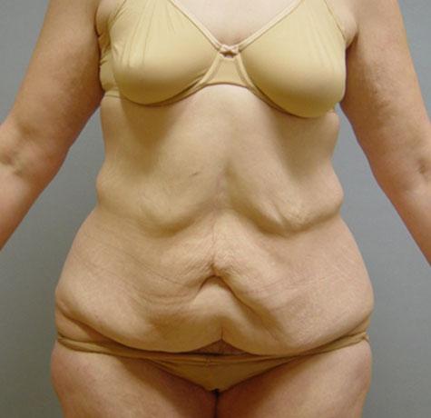 Tummy Tuck before at Neal Goldberg, MD in Scarsdale, NY