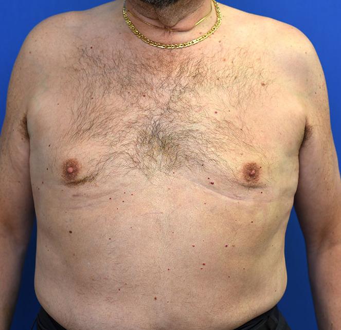 Neal Goldberg, MD liposuction after — Scarsdale, NY