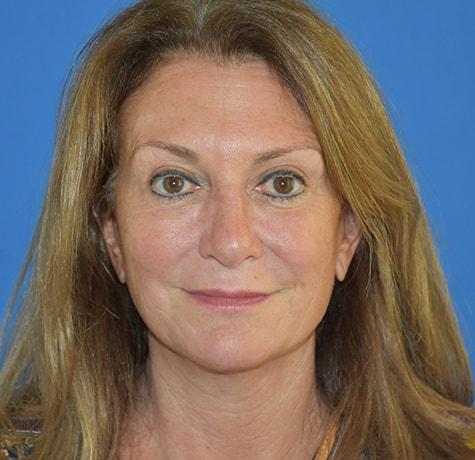 Facelift after at Neal Goldberg, MD in Scarsdale, NY