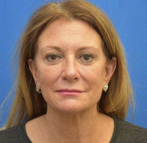 Facelift before at Neal Goldberg, MD in Scarsdale, NY