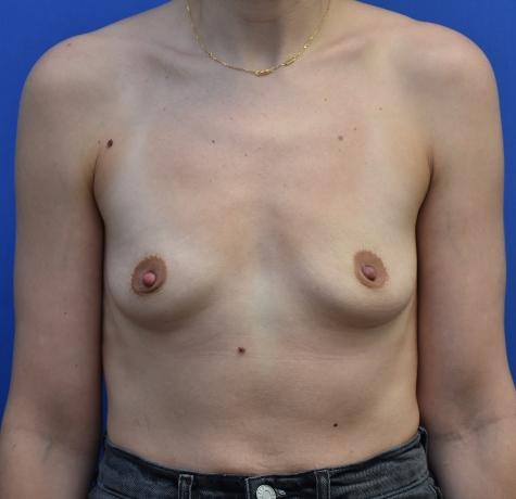 Breast Augmentation before at Neal Goldberg, MD in Scarsdale, NY