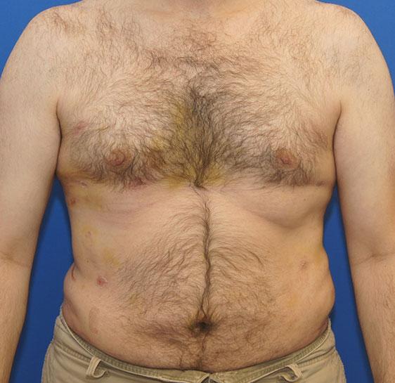 Liposuction after at Neal Goldberg, MD in Scarsdale, NY