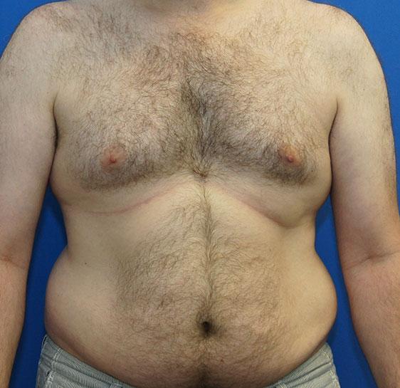 Liposuction before at Neal Goldberg, MD in Scarsdale, NY