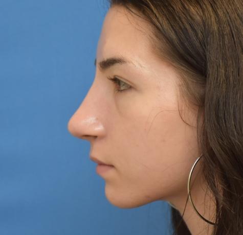 Functional Rhinoplasty after at Neal Goldberg, MD in Scarsdale, NY