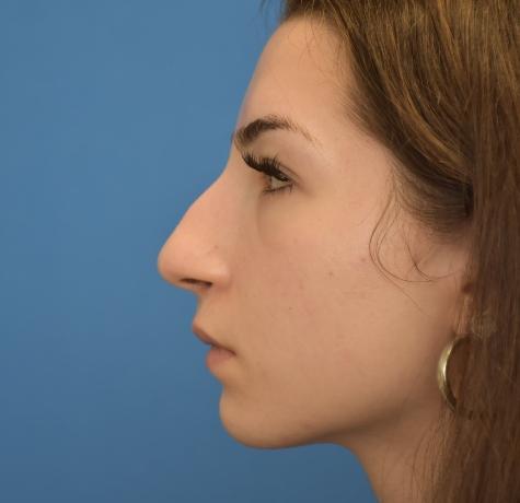 Functional Rhinoplasty before at Neal Goldberg, MD in Scarsdale, NY
