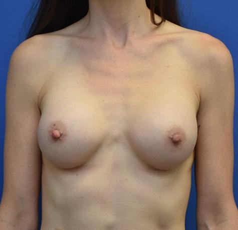 Breast Augmentation after at Neal Goldberg, MD in Scarsdale, NY