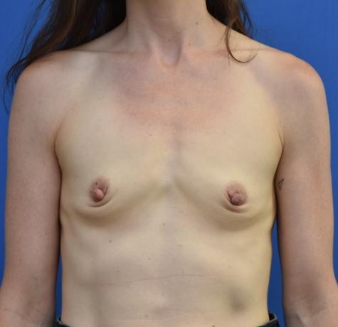 Breast Augmentation before at Neal Goldberg, MD in Scarsdale, NY