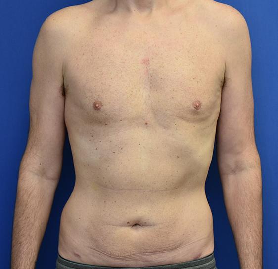 Liposuction after at Neal Goldberg, MD in Scarsdale, NY
