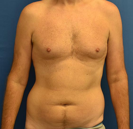 Liposuction before at Neal Goldberg, MD in Scarsdale, NY