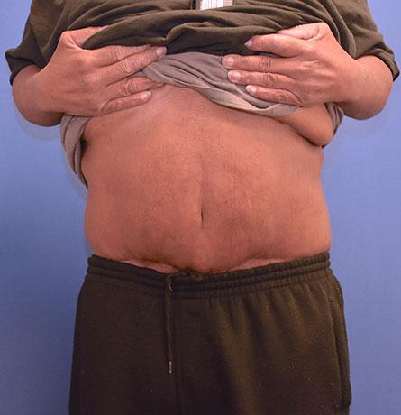 Tummy Tuck after at Neal Goldberg, MD in Scarsdale, NY