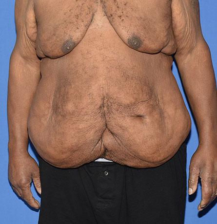 Tummy Tuck before at Neal Goldberg, MD in Scarsdale, NY