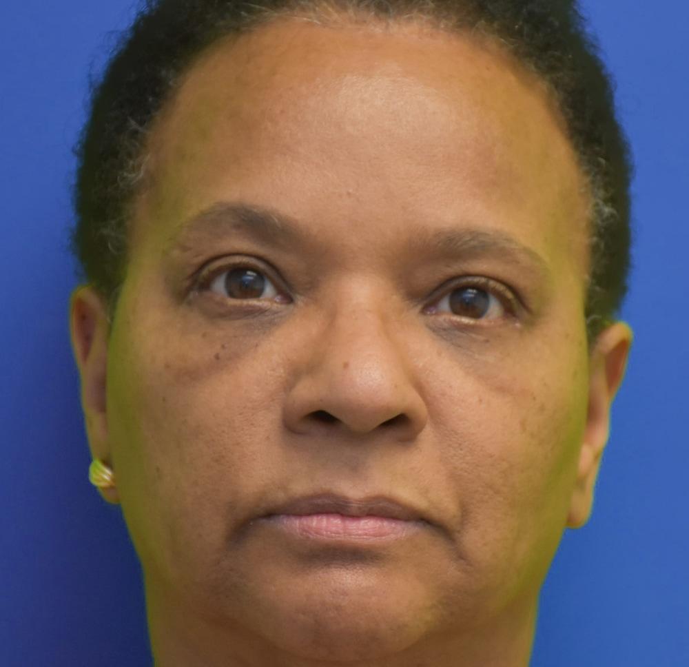 Neal Goldberg, MD blepharoplasty after — Scarsdale, NY