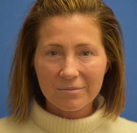Facelift after at Neal Goldberg, MD in Scarsdale, NY