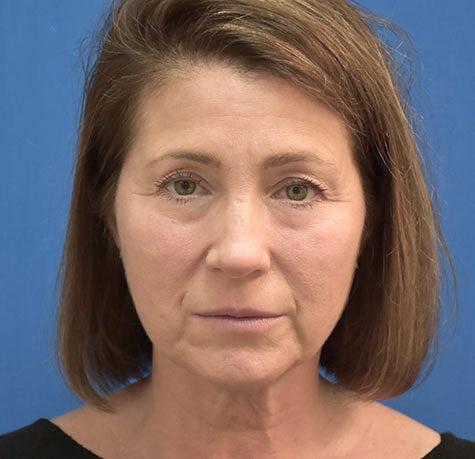 Facelift before at Neal Goldberg, MD in Scarsdale, NY