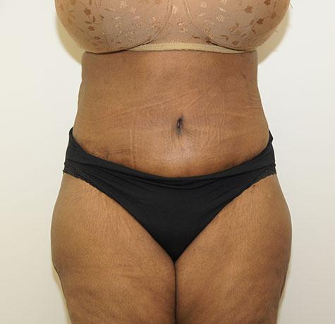 Tummy Tuck after at Neal Goldberg, MD in Scarsdale, NY