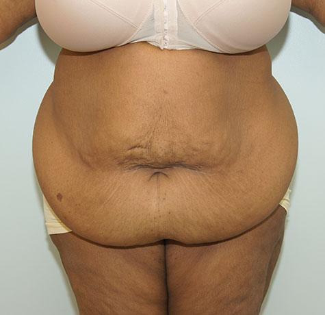 Tummy Tuck before at Neal Goldberg, MD in Scarsdale, NY