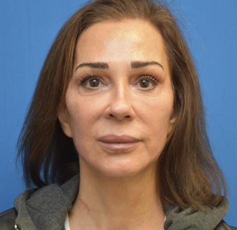 Facelift after at Neal Goldberg, MD in Scarsdale, NY