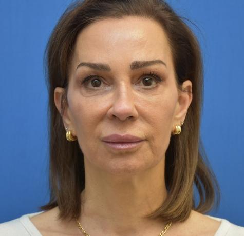 Facelift before at Neal Goldberg, MD in Scarsdale, NY