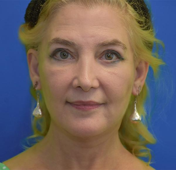 Chin Implant after at Neal Goldberg, MD in Scarsdale, NY