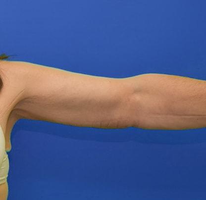 Arm Lift after at Neal Goldberg, MD in Scarsdale, NY