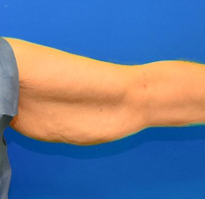 Arm Lift before at Neal Goldberg, MD in Scarsdale, NY