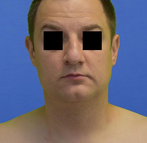 Neal Goldberg, MD liposuction after — Scarsdale, NY