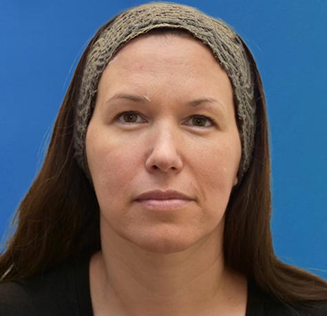 Neal Goldberg, MD facelift after — Scarsdale, NY