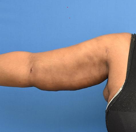 Arm Lift after at Neal Goldberg, MD in Scarsdale, NY