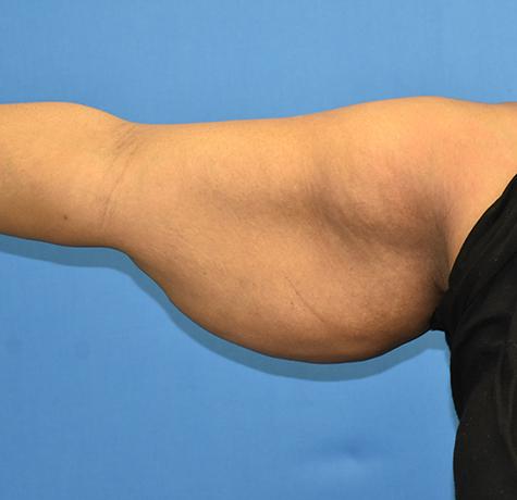 Arm Lift before at Neal Goldberg, MD in Scarsdale, NY