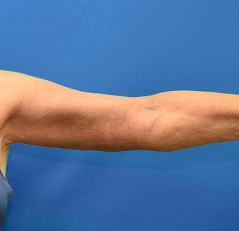 Arm Lift after at Neal Goldberg, MD in Scarsdale, NY