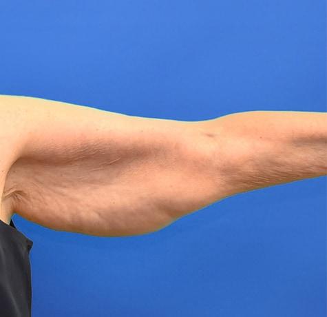 Arm Lift before at Neal Goldberg, MD in Scarsdale, NY