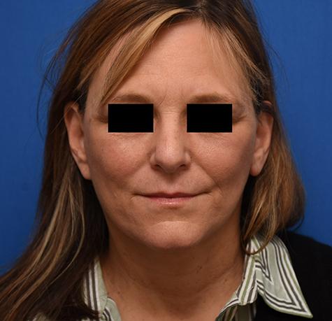 Neck Lift after at Neal Goldberg, MD in Scarsdale, NY