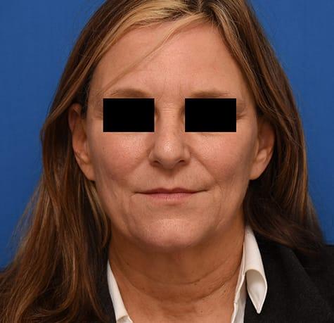 Neck Lift before at Neal Goldberg, MD in Scarsdale, NY