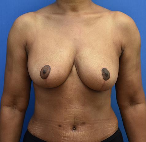 Breast Reduction after at Neal Goldberg, MD in Scarsdale, NY