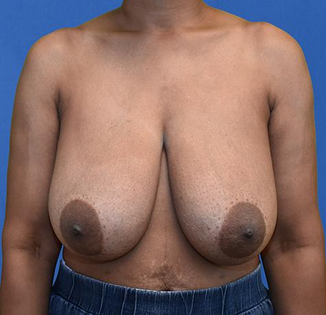 Breast Reduction before at Neal Goldberg, MD in Scarsdale, NY