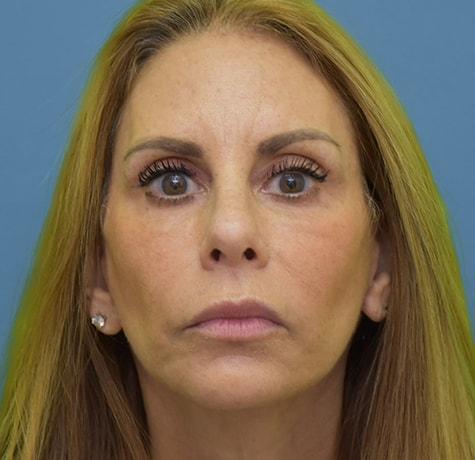 Facelift after at Neal Goldberg, MD in Scarsdale, NY