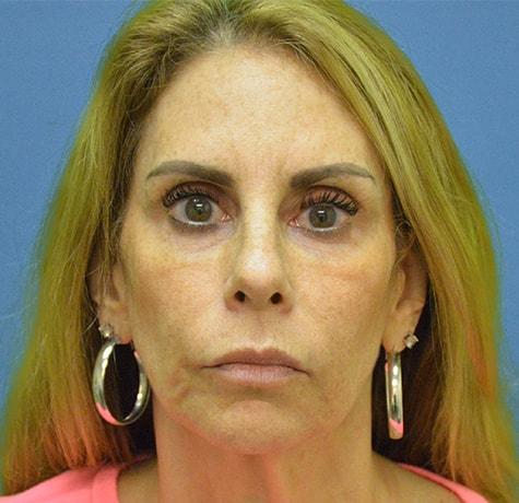 Facelift before at Neal Goldberg, MD in Scarsdale, NY