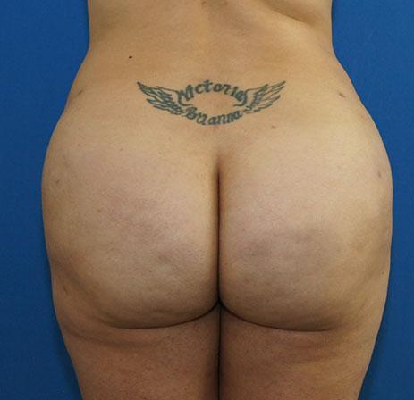 Neal Goldberg, MD bbl after — Scarsdale, NY