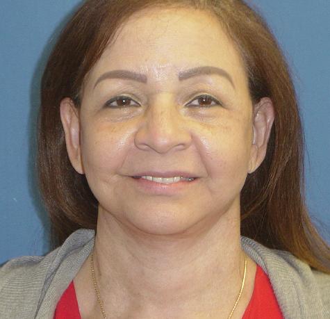 Facelift after at Neal Goldberg, MD in Scarsdale, NY