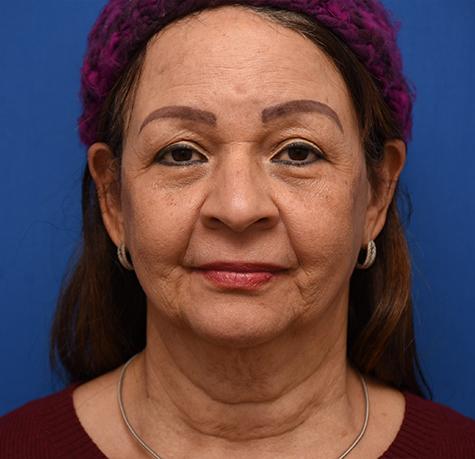 Facelift before at Neal Goldberg, MD in Scarsdale, NY