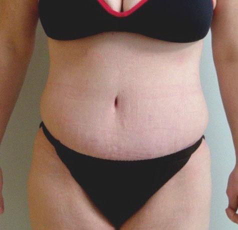 Tummy Tuck after at Neal Goldberg, MD in Scarsdale, NY