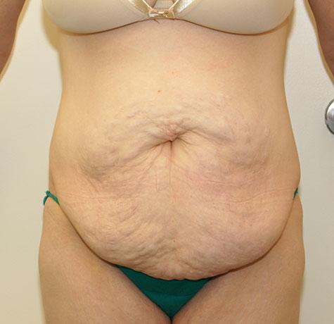 Tummy Tuck before at Neal Goldberg, MD in Scarsdale, NY