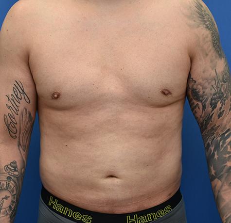 Liposuction after at Neal Goldberg, MD in Scarsdale, NY