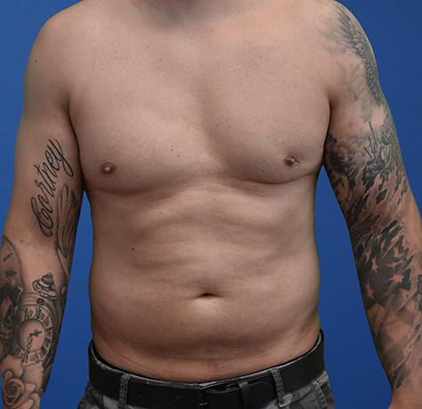 Liposuction before at Neal Goldberg, MD in Scarsdale, NY