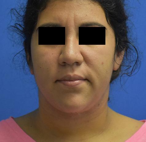 Neal Goldberg, MD liposuction after — Scarsdale, NY