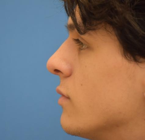 Functional Rhinoplasty after at Neal Goldberg, MD in Scarsdale, NY