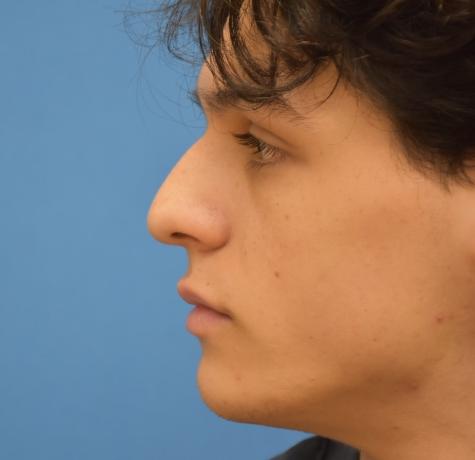 Functional Rhinoplasty before at Neal Goldberg, MD in Scarsdale, NY