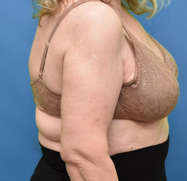 Liposuction after at Neal Goldberg, MD in Scarsdale, NY