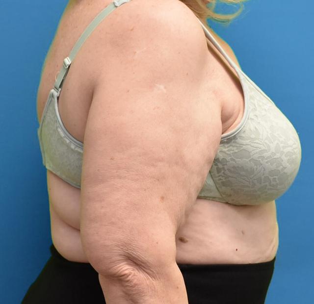 Liposuction before at Neal Goldberg, MD in Scarsdale, NY